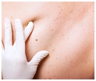 PEO Solution As Skin Cancer Solution